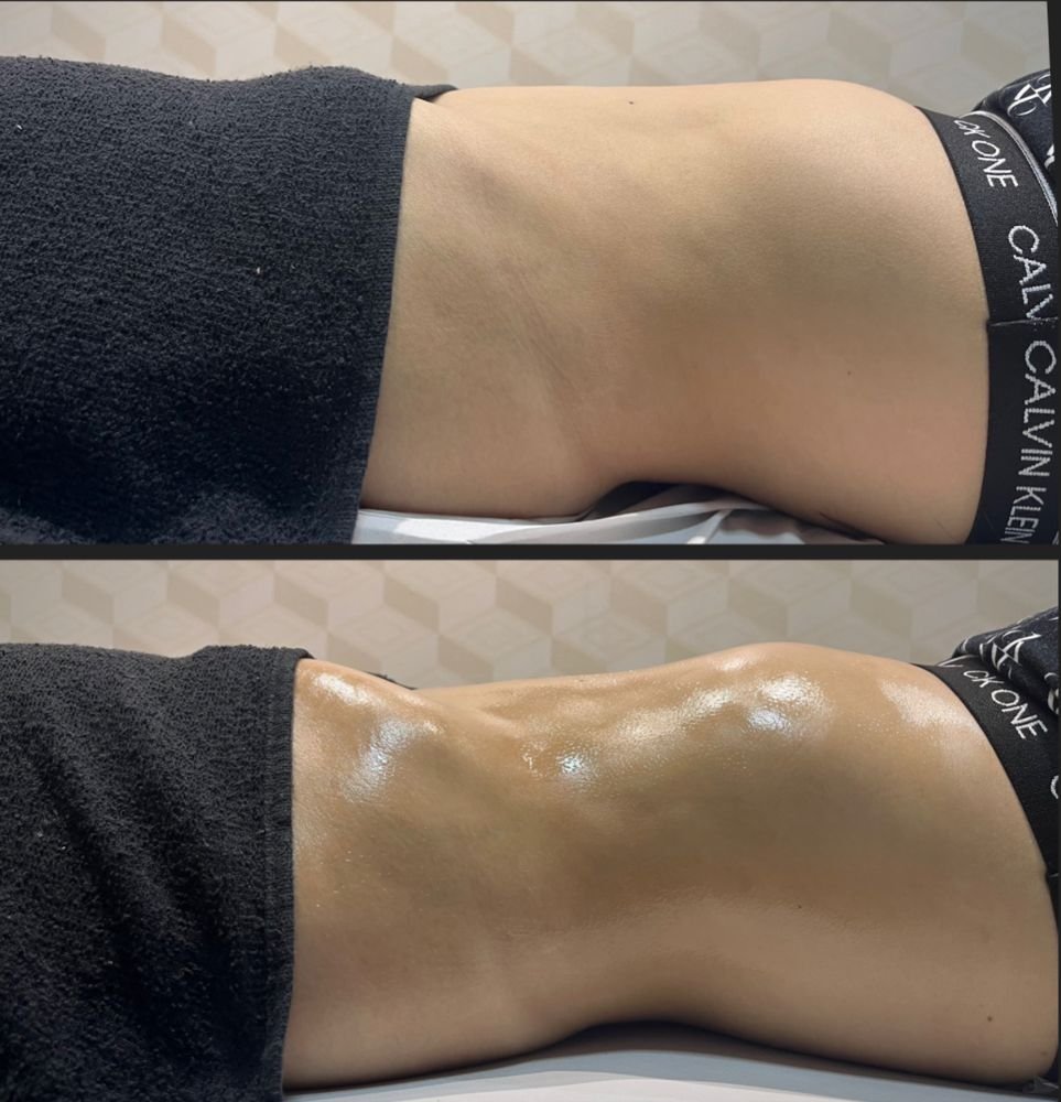 Antes e depois de drenagem linfática — Drenagem HD por Bia Aneli Estética (caso 1)