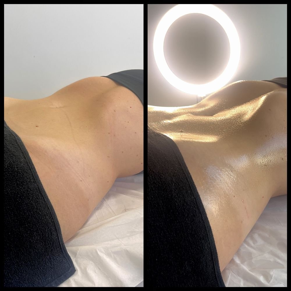 Antes e depois de drenagem linfática — Drenagem HD por Bia Aneli Estética (caso 2)