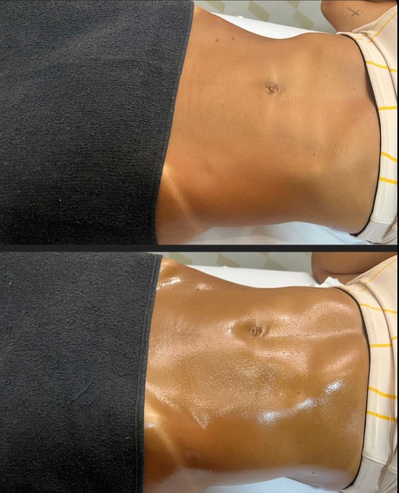 Antes e depois de drenagem linfática — Drenagem HD por Bia Aneli Estética (caso 3)