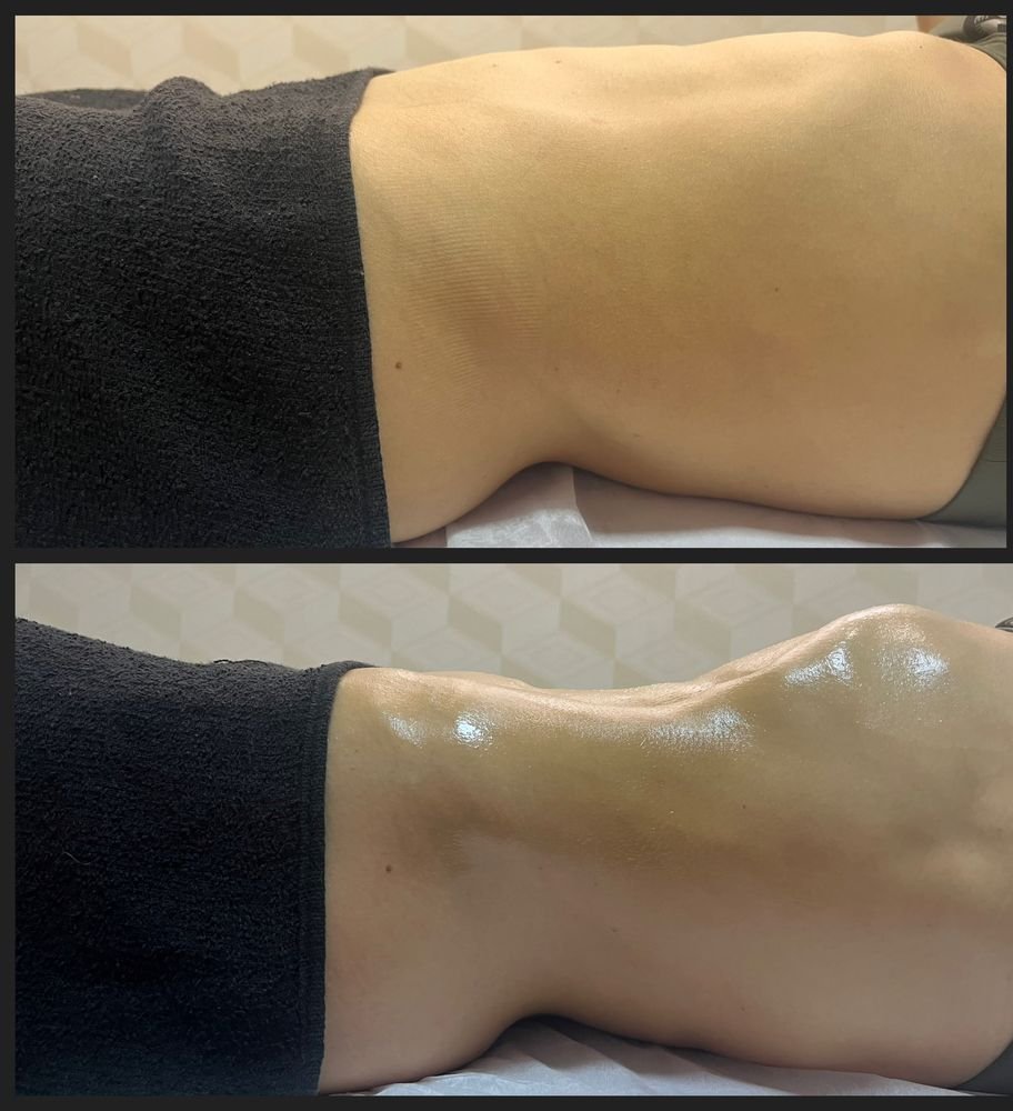 Antes e depois de drenagem linfática — Drenagem HD por Bia Aneli Estética (caso 5)