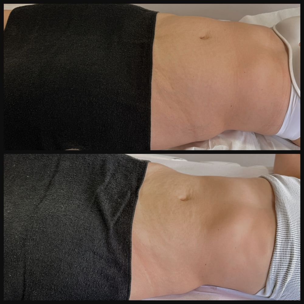 Antes e depois de drenagem linfática — Drenagem HD por Bia Aneli Estética (caso 7)