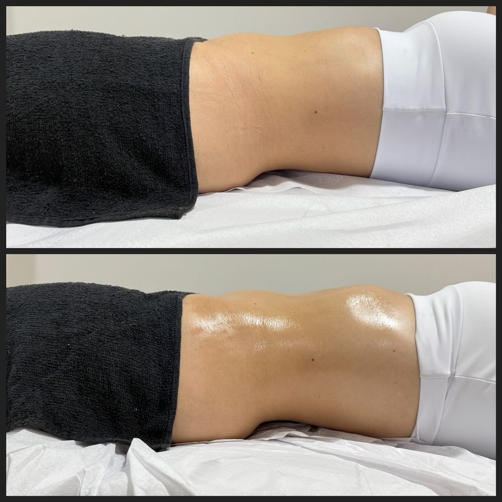 Antes e depois de drenagem linfática — Drenagem HD por Bia Aneli Estética (caso 10)