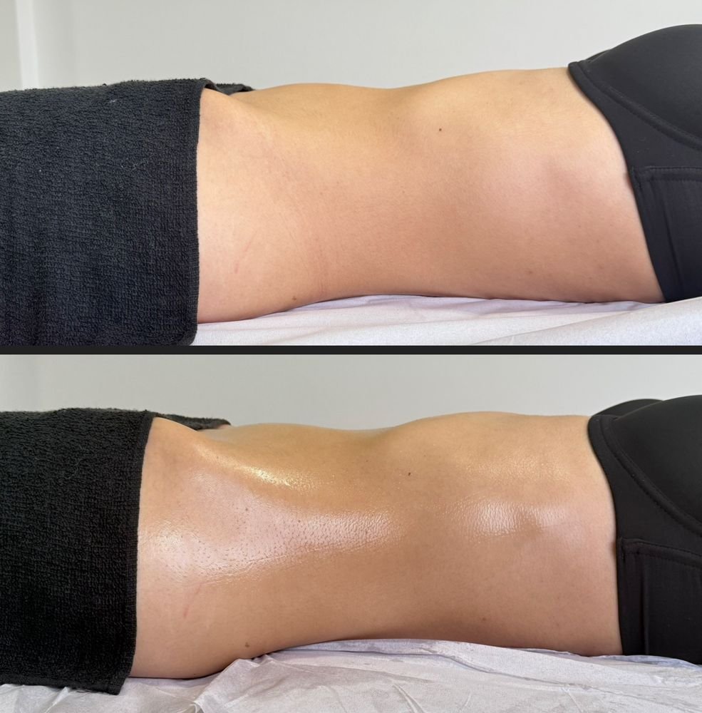 Antes e depois de drenagem linfática — Drenagem HD por Bia Aneli Estética (caso 11)