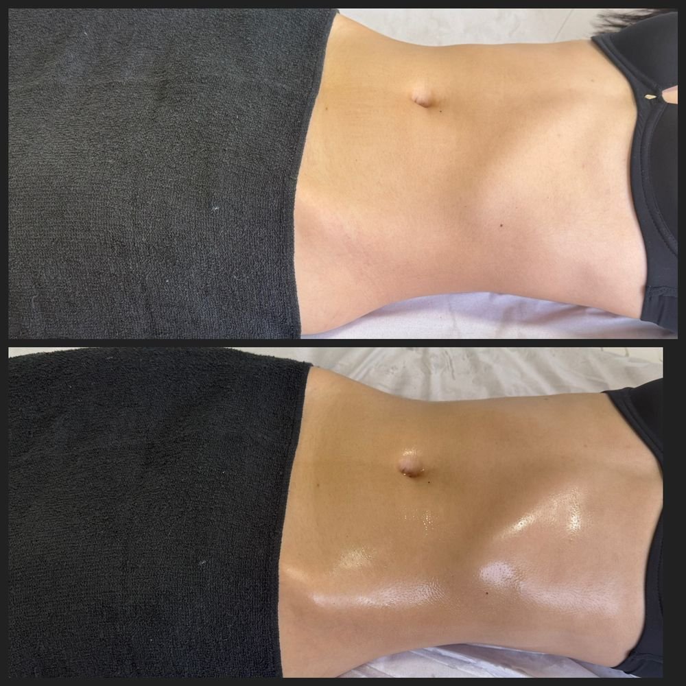 Antes e depois de drenagem linfática — Drenagem HD por Bia Aneli Estética (caso 12)